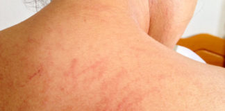 Home Remedies to Heal Skin Rashes Home Remedies to Heal Skin Rashes