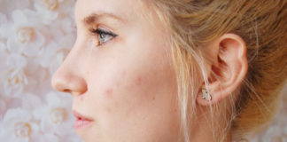 5 Most Effective Home Remedy To Remove Acne Scars Or Pimple Marks Home Remedy To Remove Acne Scars
