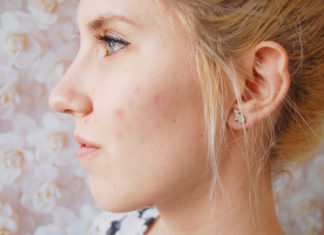 5 Most Effective Home Remedy To Remove Acne Scars Or Pimple Marks Home Remedy To Remove Acne Scars