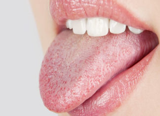 7 Effective Home Remedies For Furry Tongue Furry Tongue
