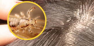 6 Effective Home Remedies For Lice home remedies for lice