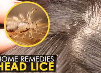 6 Effective Home Remedies For Lice home remedies for lice