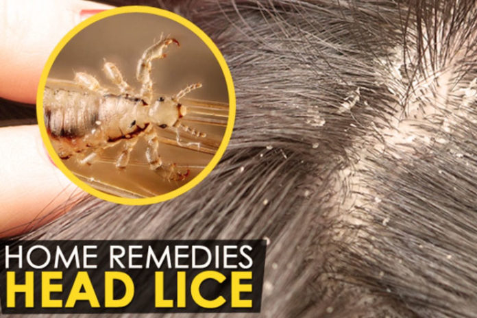 home remedies for lice