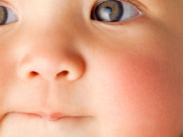 10 Common Skin Rashes in Children skin rashes in children