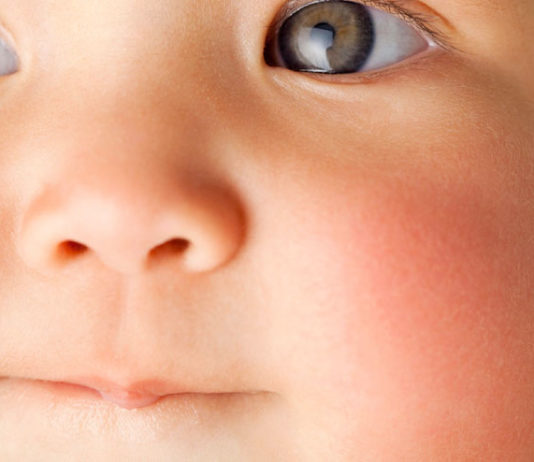 10 Common Skin Rashes in Children skin rashes in children