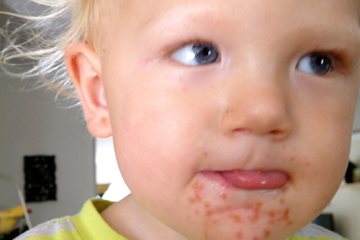 10 Common Skin Rashes In Children