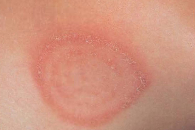 10 Common Skin Rashes In Children