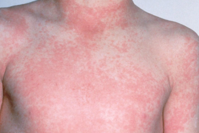 10 Common Rashes Skin Chart