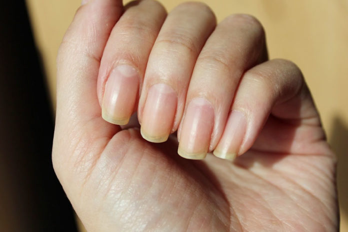 get rid of yellow nails