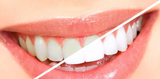 Natural remedies for teeth whitening remedies for teeth whitening