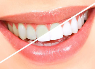 Natural remedies for teeth whitening remedies for teeth whitening