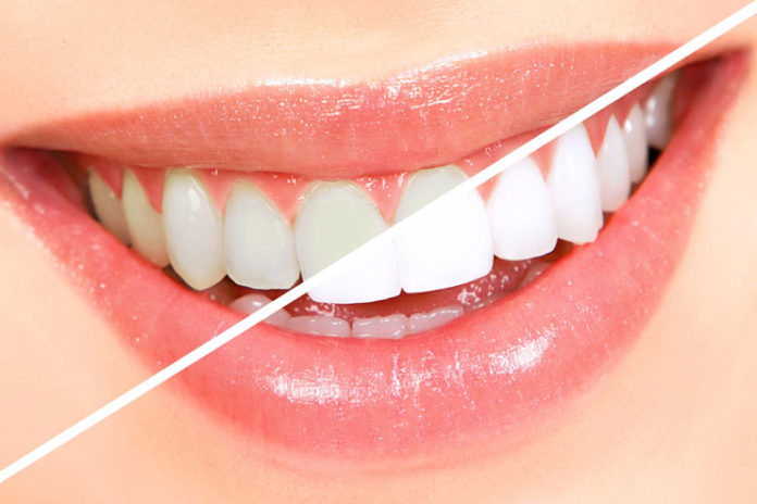 remedies for teeth whitening