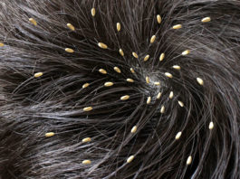 4 Best Ways To Get Rid Of Nits And Lice get rid of nits and lice