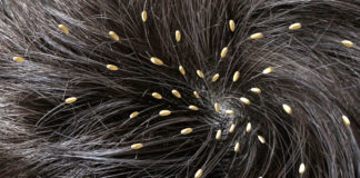 4 Best Ways To Get Rid Of Nits And Lice get rid of nits and lice