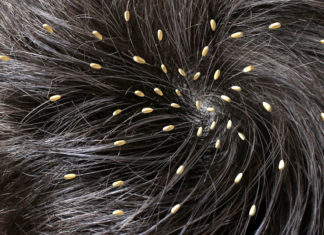 4 Best Ways To Get Rid Of Nits And Lice get rid of nits and lice