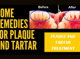Home Remedies to Remove Tartar And Plaque From Teeth home remedies to remove tartar