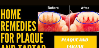 Home Remedies to Remove Tartar And Plaque From Teeth home remedies to remove tartar