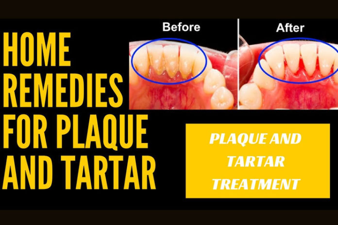 home remedies to remove tartar