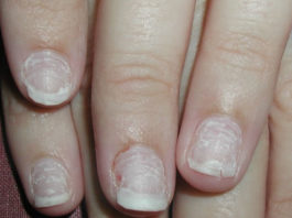 12 Beauty Hacks For Repairing Damaged Nails repairing damaged nails