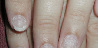 12 Beauty Hacks For Repairing Damaged Nails repairing damaged nails