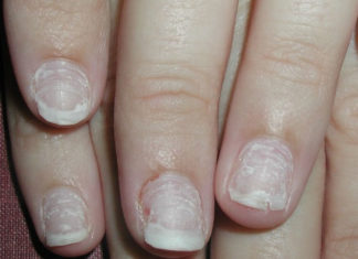 12 Beauty Hacks For Repairing Damaged Nails repairing damaged nails