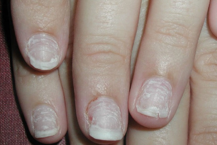 repairing damaged nails