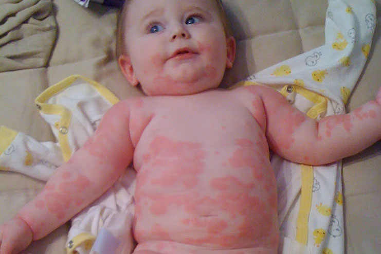 Milk Allergy Symptoms In Babies Milk Allergy Treatment