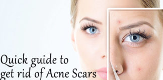 How to Get Rid of Acne Blemishes Home Remedies acne blemishes home remedies