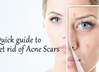 How to Get Rid of Acne Blemishes Home Remedies acne blemishes home remedies