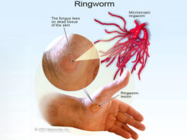 Causes and Home Remedy for Ringworm home remedy for ringworm
