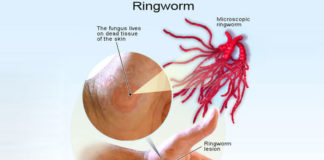 Causes and Home Remedy for Ringworm home remedy for ringworm