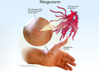 Causes and Home Remedy for Ringworm home remedy for ringworm