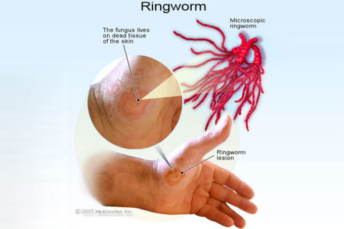 home remedy for ringworm