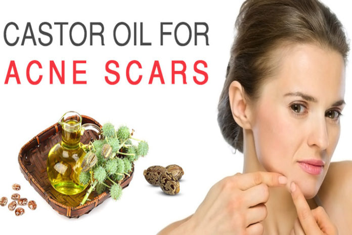 castor oil for acne