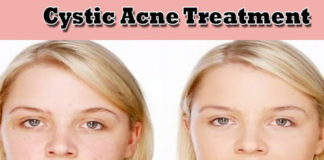 What is Cystic Acne and How to Treat it at Home Naturally cystic acne