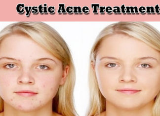 What is Cystic Acne and How to Treat it at Home Naturally cystic acne