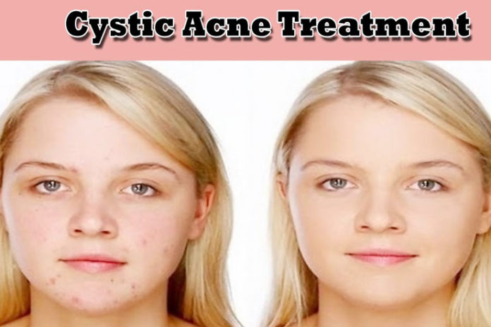 cystic acne