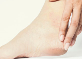 Top 22 Home Remedies to Remove Dead Skin on Feet Dead-Skin-On-Feet