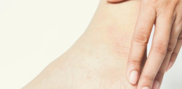 Top 22 Home Remedies to Remove Dead Skin on Feet Dead-Skin-On-Feet