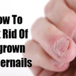 How to Treat Ingrown Fingernails ingrown fingernails