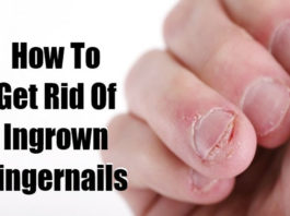 How to Treat Ingrown Fingernails ingrown fingernails
