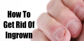 How to Treat Ingrown Fingernails ingrown fingernails