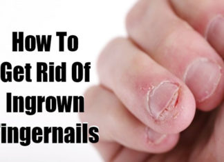 How to Treat Ingrown Fingernails ingrown fingernails