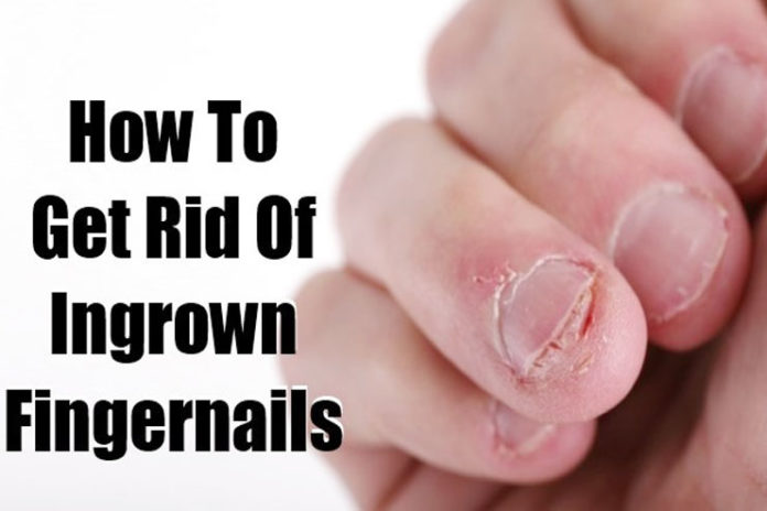 ingrown fingernails