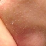 Understanding Sebaceous Filaments and How to Reduce Their Appearance Understanding sebaceous filaments