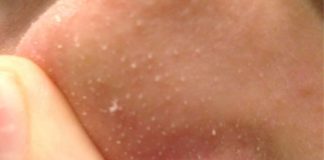 Understanding Sebaceous Filaments and How to Reduce Their Appearance Understanding sebaceous filaments