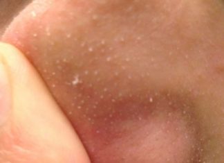 Understanding Sebaceous Filaments and How to Reduce Their Appearance Understanding sebaceous filaments