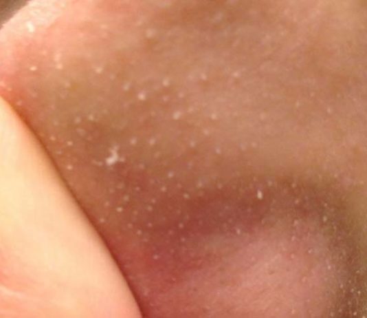 Understanding Sebaceous Filaments and How to Reduce Their Appearance Understanding sebaceous filaments