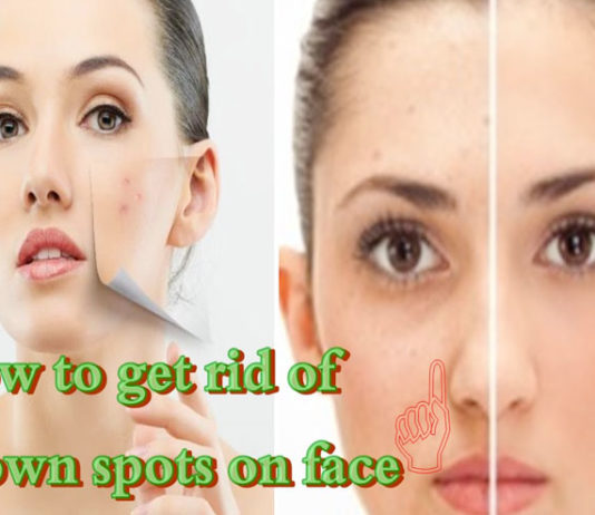 What are these Brown Spots on Face and How to Treat Them brown spots on face