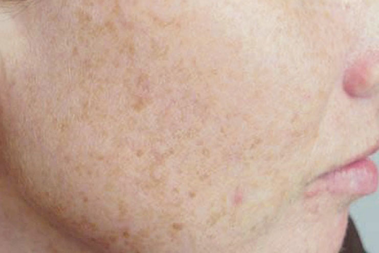 What Are These Brown Spots On Face And How To Treat Them